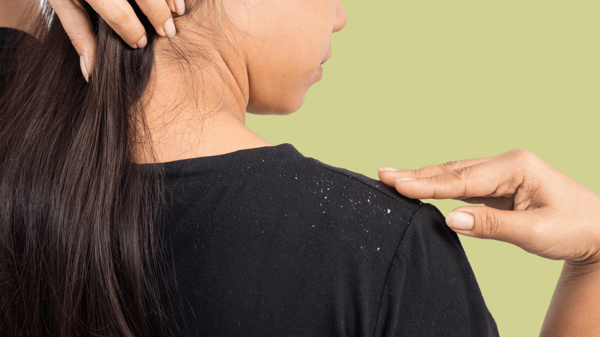 Top 5 Winning Natural Antidotes for Dandruff - pure•yeva